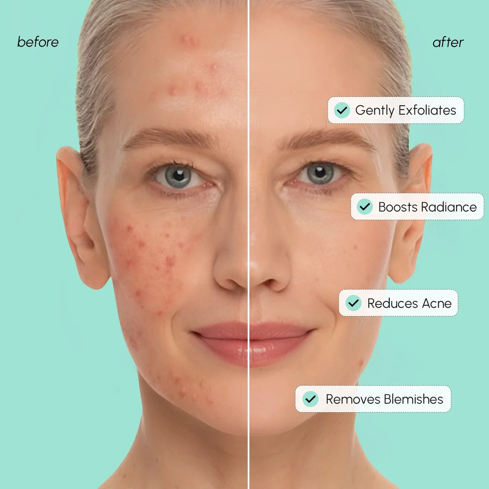Miếng đệm làm dịu da Azelaic Acid