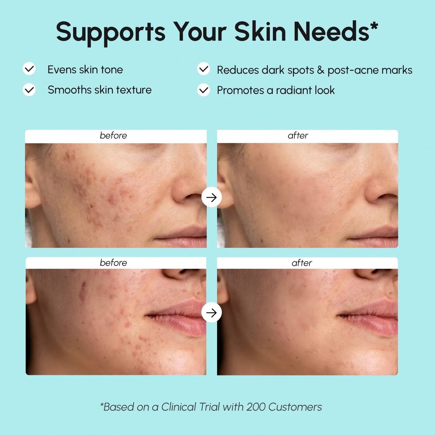 Kem Azelaic Acid cho da nhạy cảm